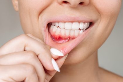 Plaies dans la bouche qui ne guérissent pas, quand s’inquiéter